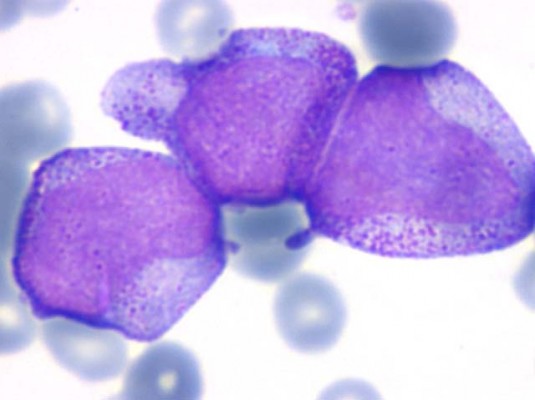 2553_leucocitosis